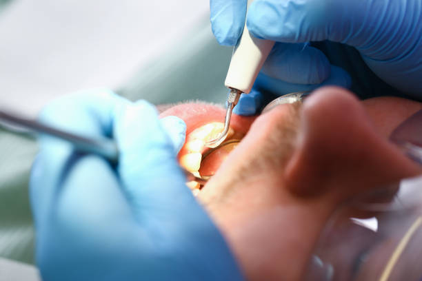 Best Emergency Dentist for Lost Fillings or Crowns in Bad Axe, MI